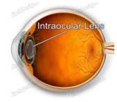 Lens Implants, Crystalens, IOL Intraocular Lens Implant Treatment Bangalore India, Cataract Surgery